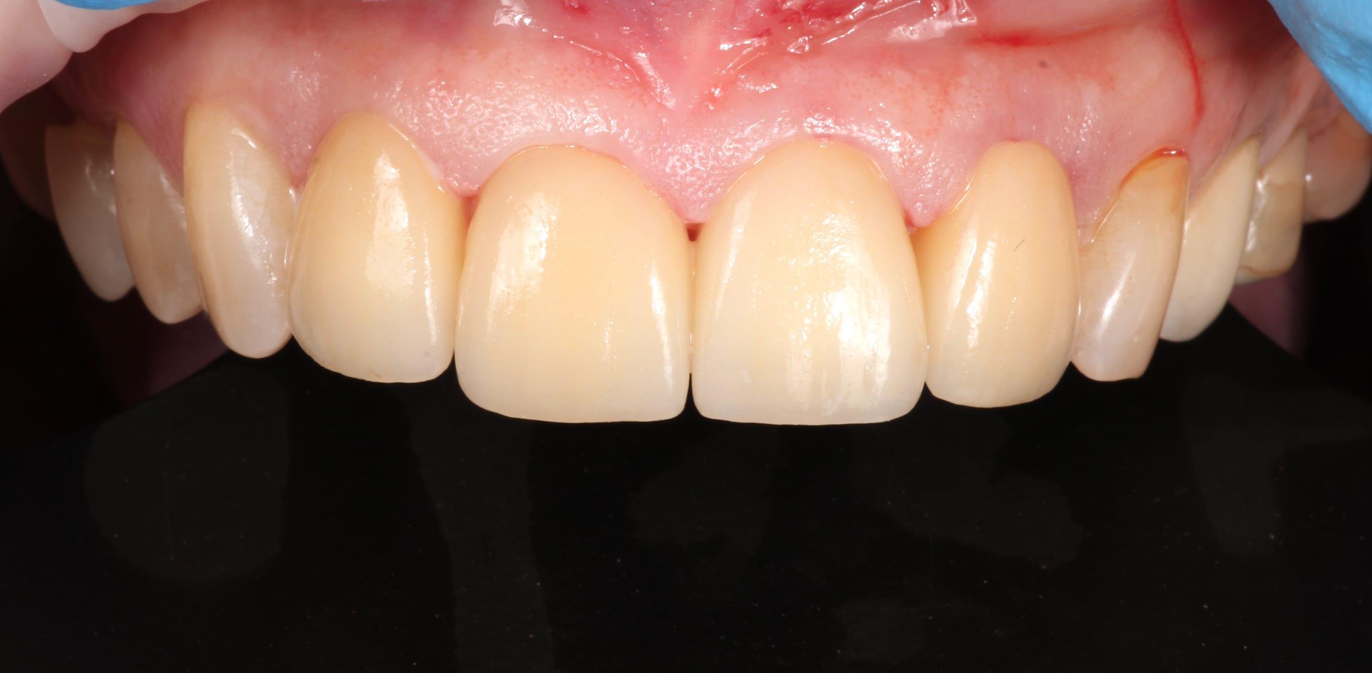 Ceramic veneers in the anterior segment
