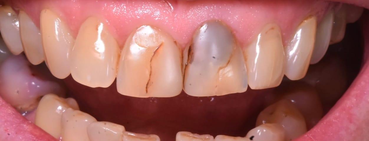 Before treatment — old fillings in the anterior segment