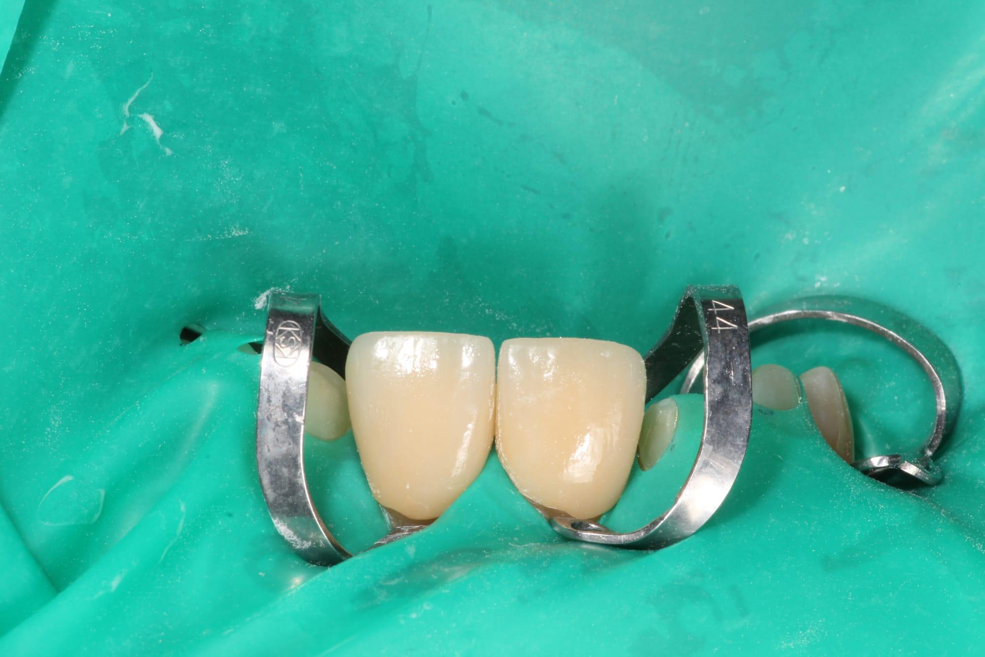 Treatment stage — ceramic veneers after bonding