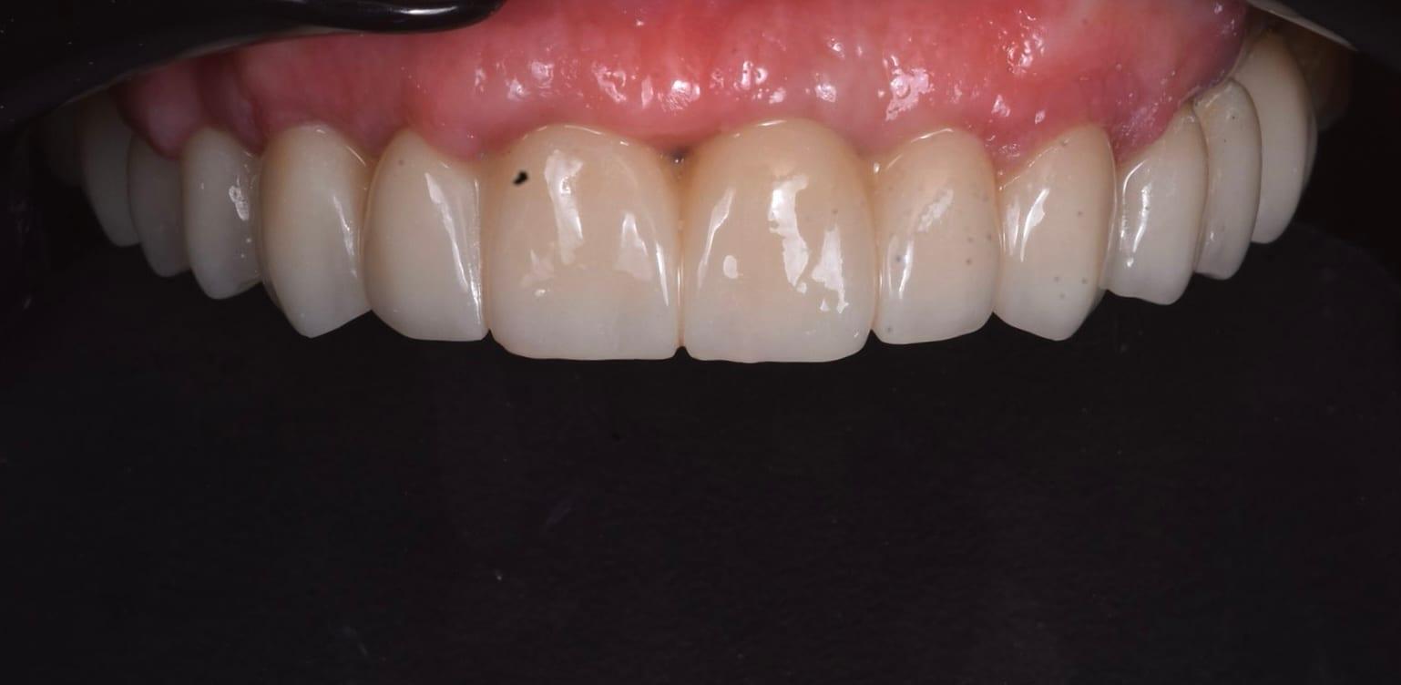Zirconia construction on a titanium bar