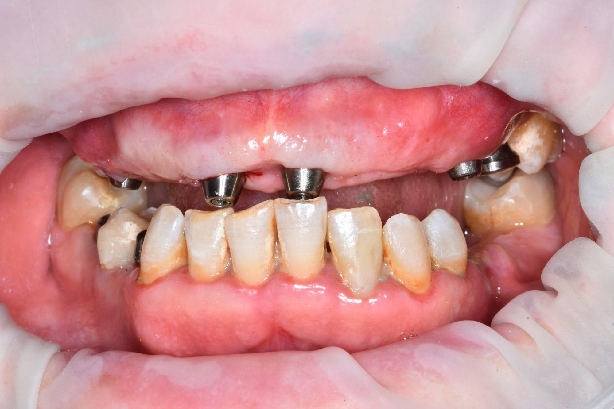 Before treatment — old bridges in place