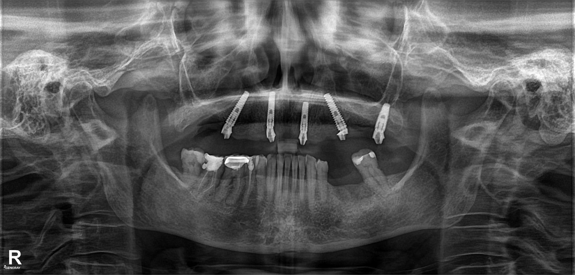 Treatment stage — fragment 3