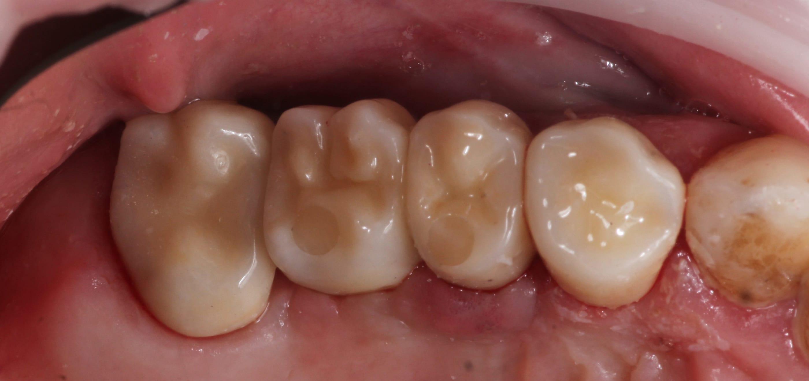 Implant-supported crowns in the posterior segment