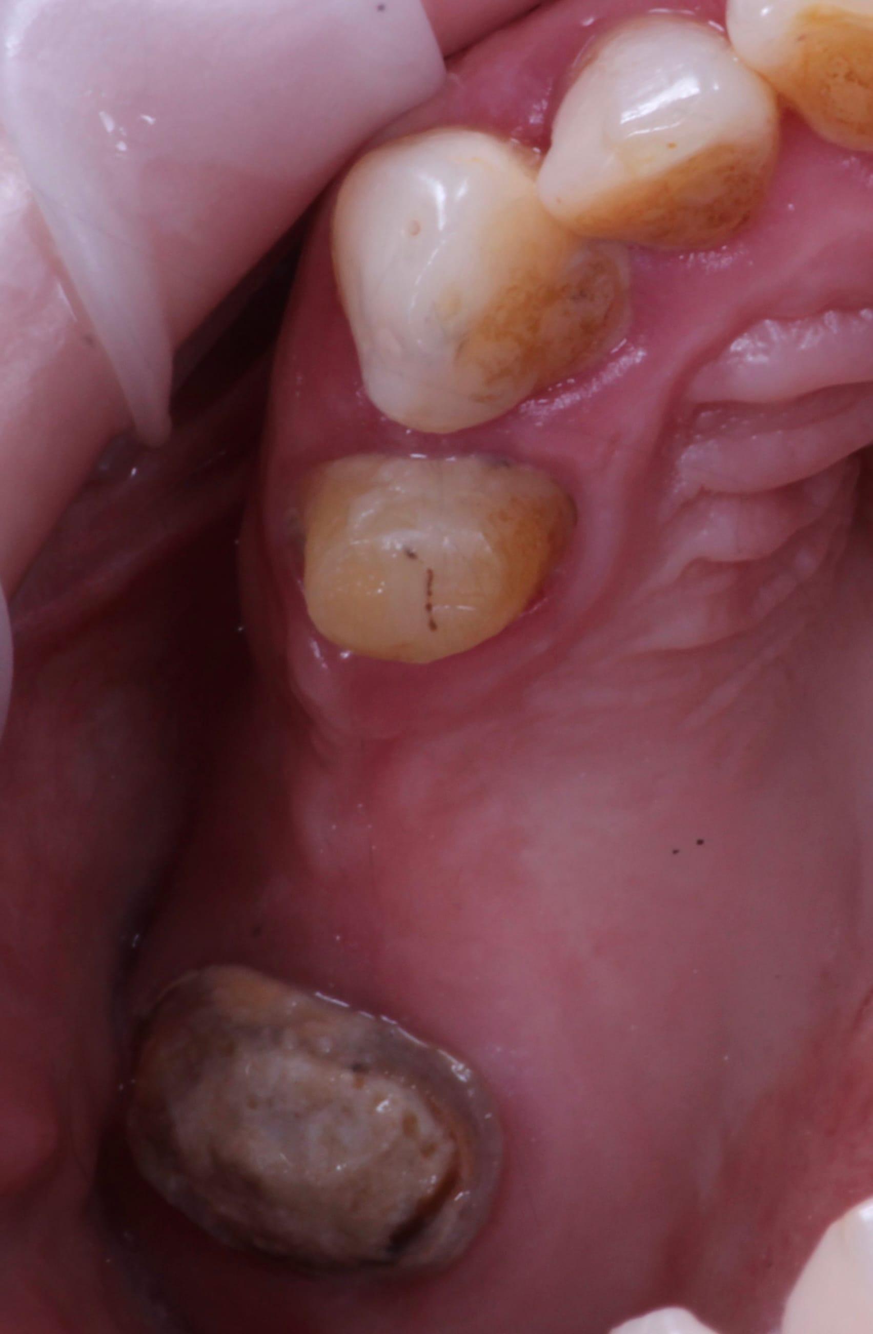 Before treatment — missing chewing teeth