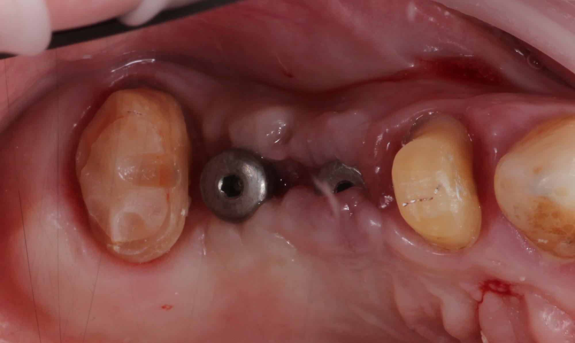 Treatment stage — implants placed