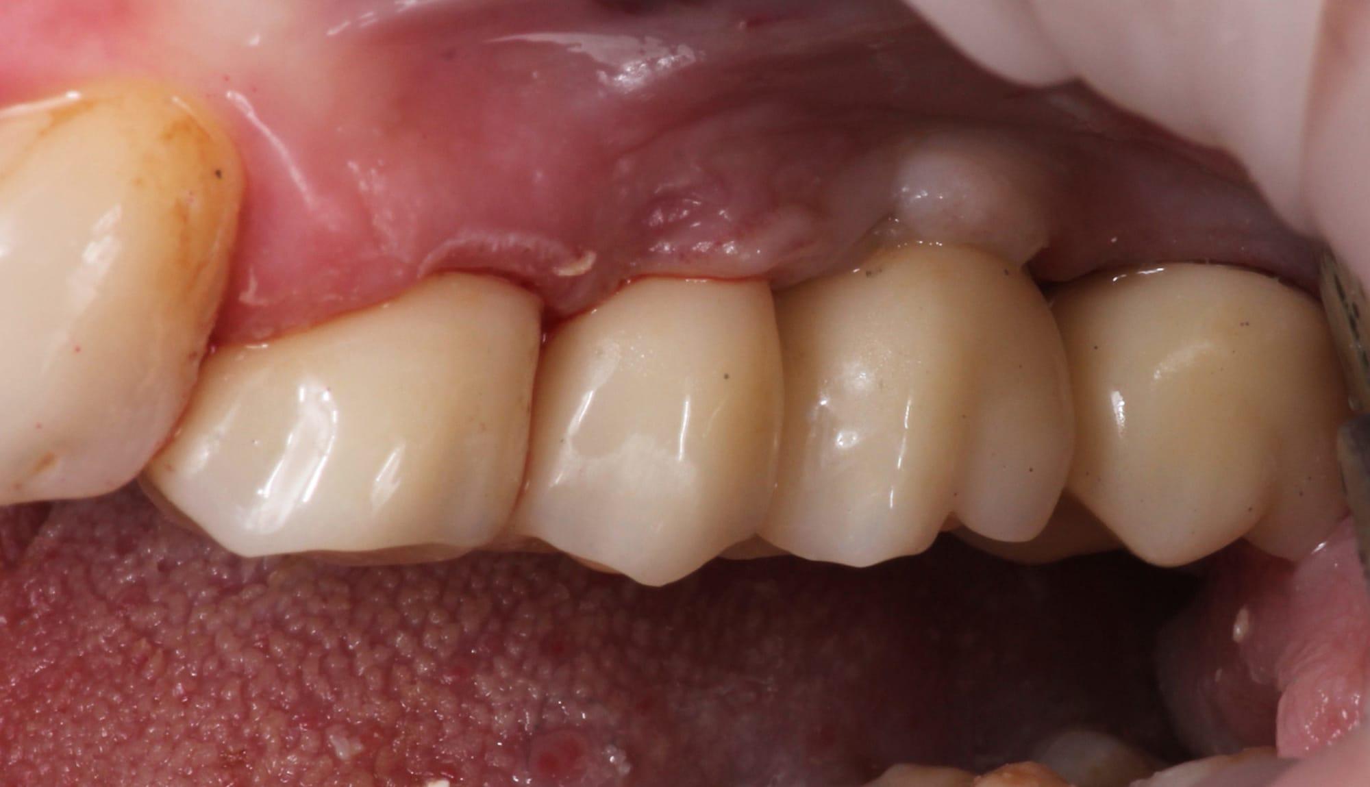 Treatment stage — crowns bonded