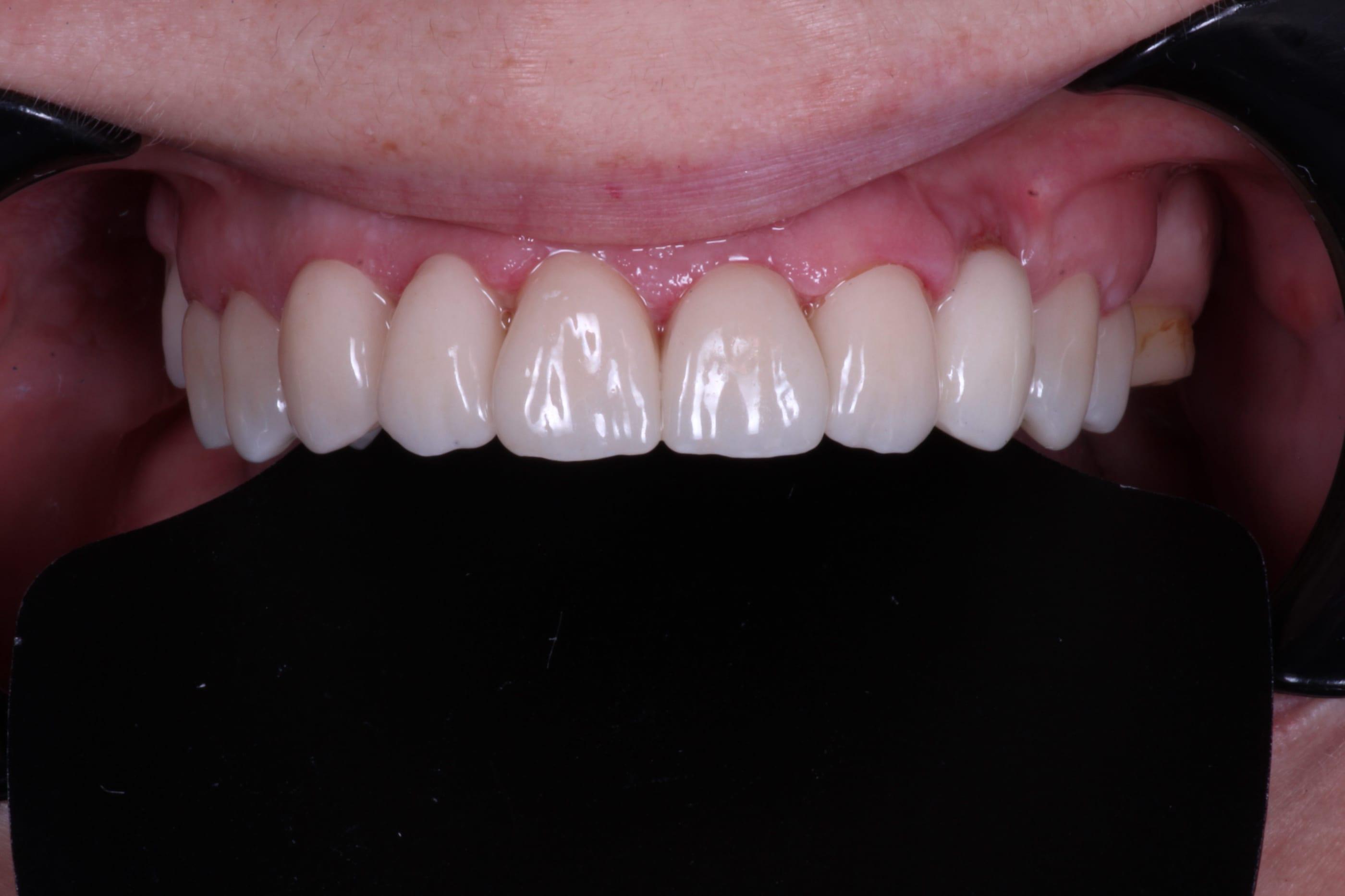 Ceramic smile rehabilitation — frontal view