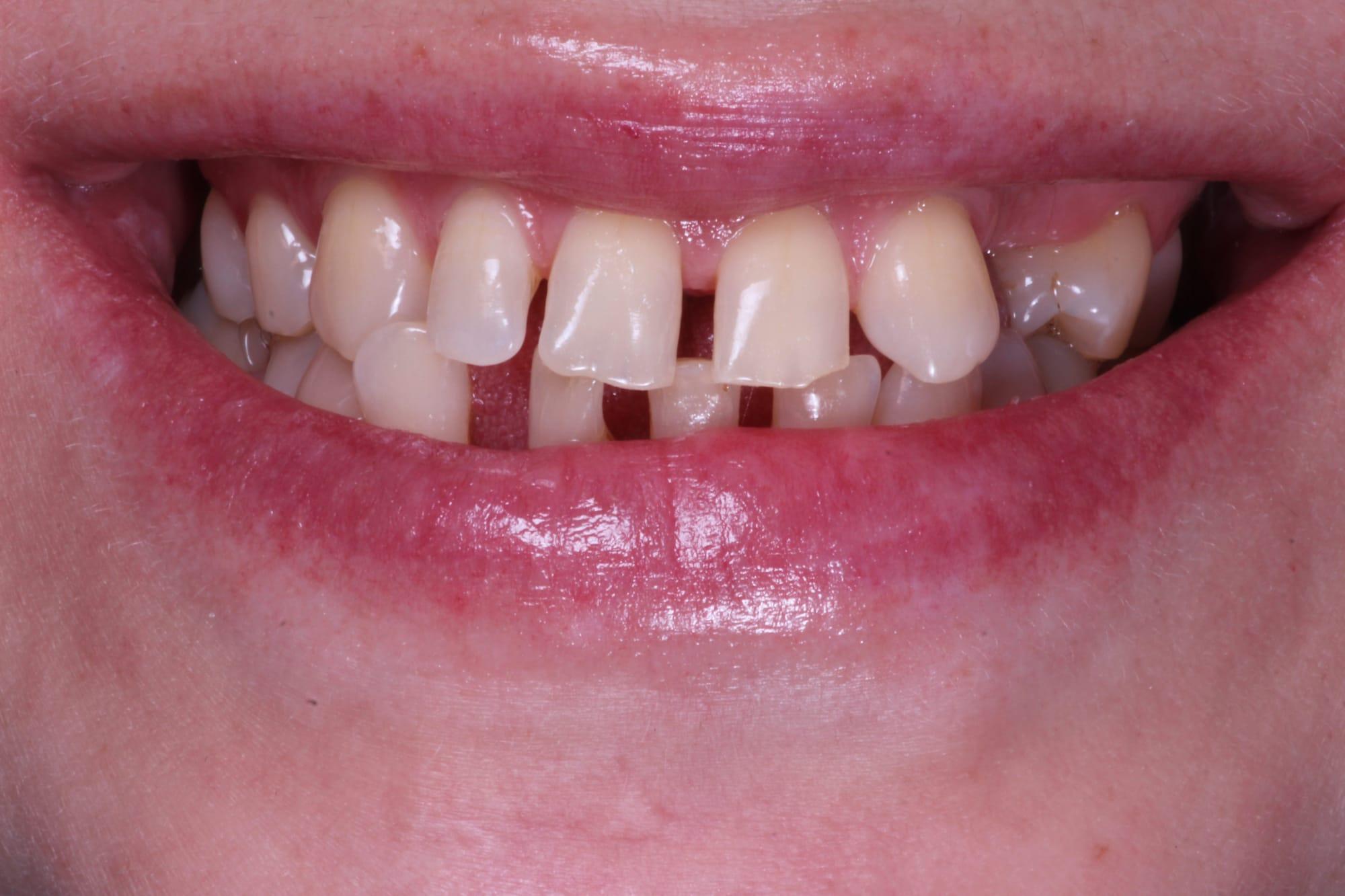 Before treatment — interdental gaps in the smile zone