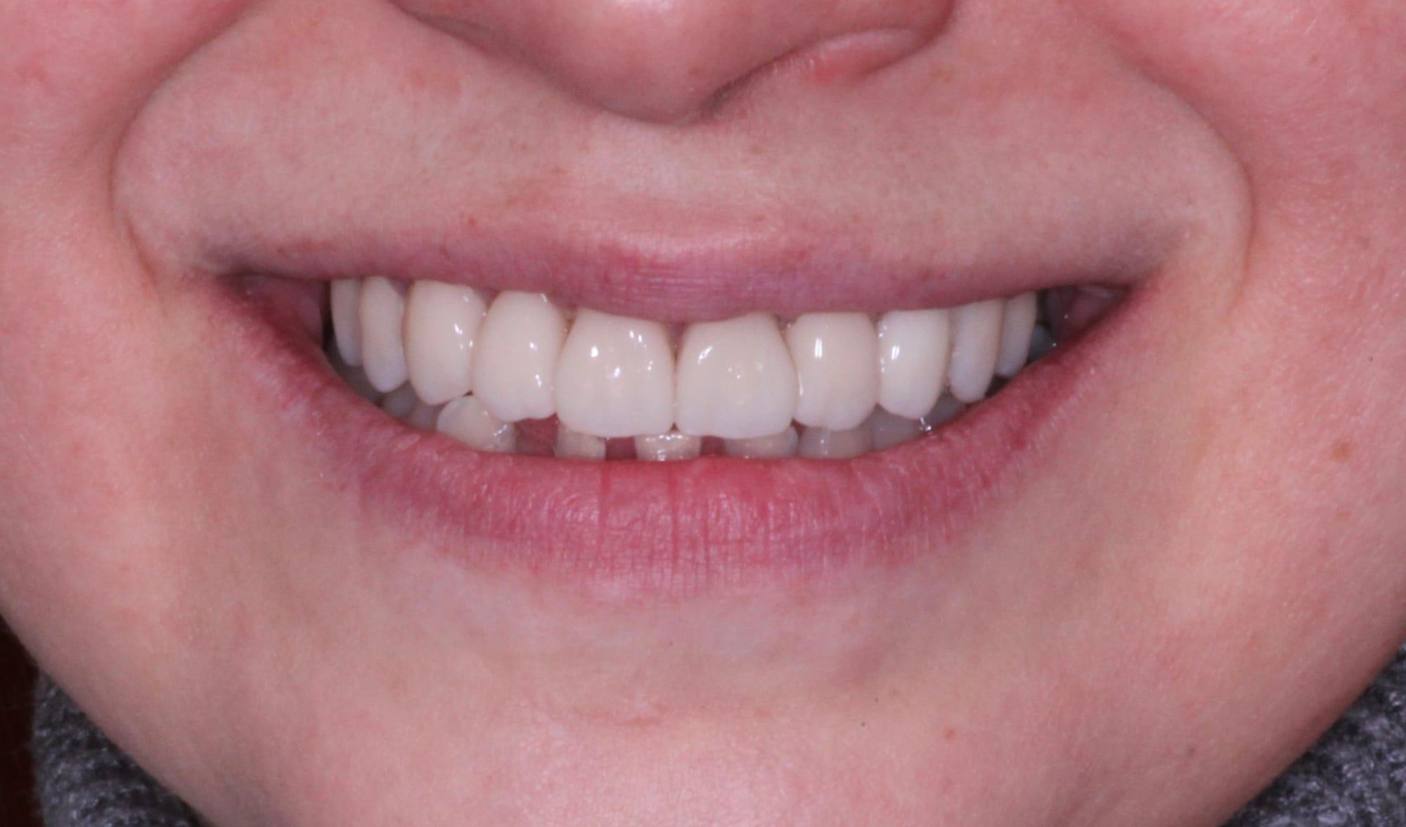 Treatment stage — mock-up try-in