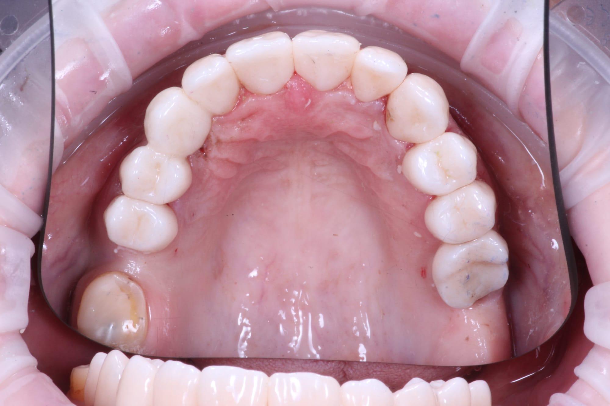 Treatment stage — ceramic restorations bonded